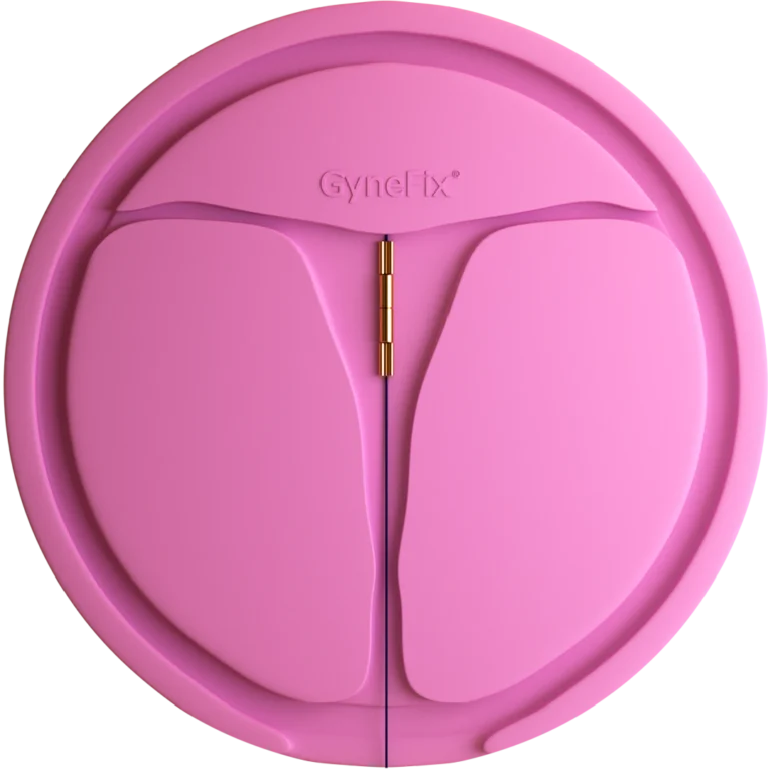 GyneFix copper chain and thread positioned in a uterine demonstration model