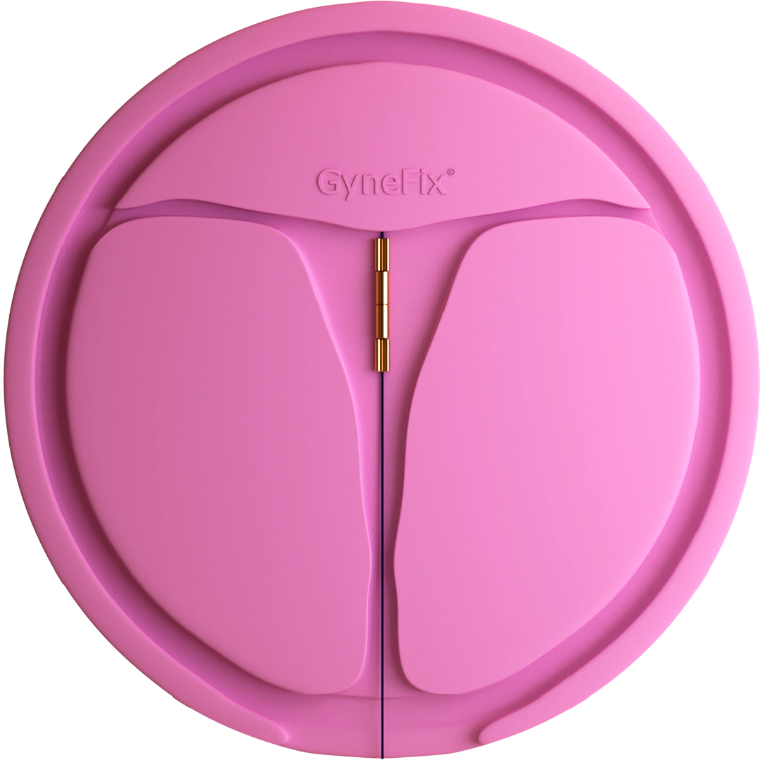 GyneFix’in rahim modeli üzerinde gösterilen yerleşimi