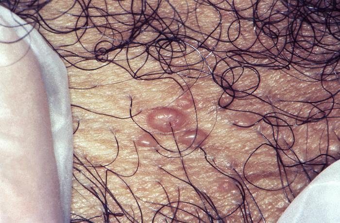 Molluscum contagiosumda görülebilen parlak, kubbe biçimli ve ortası çökük deri kabarıklıkları; CDC klinik arşiv fotoğrafı